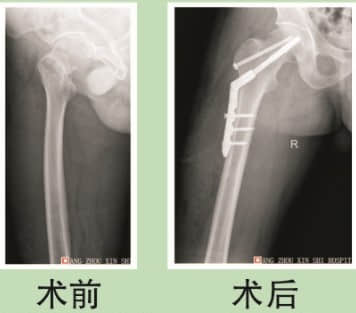 陈荣芬,男,49岁,因"右侧股骨颈基底部骨折"入本院,实施动力髋内